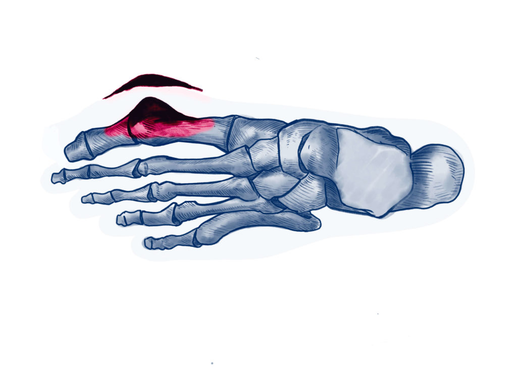 Pathologies Pied ISCO Institut Spécialisé de Chirurgie Orthopédique à StrasbourgISCO