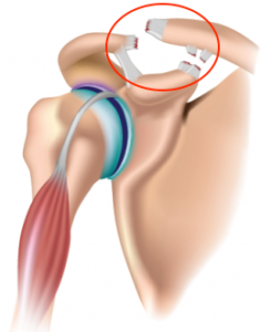 Luxation acromioclaviculaire ISCO Institut Spécialisé de Chirurgie Orthopédique à