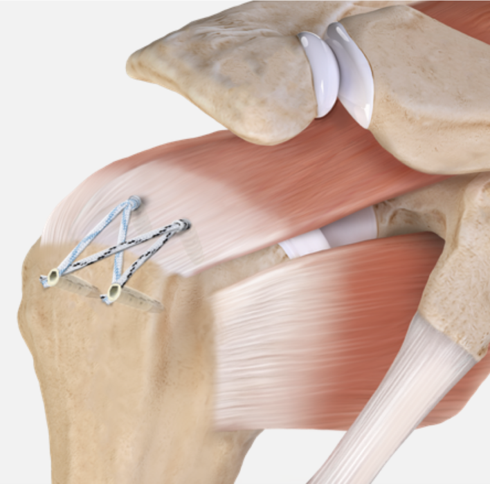 Rupture de la coiffe des rotateurs ISCO Institut Spécialisé de Chirurgie Orthopédique à