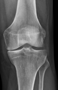 Arthrose du genou (Gonarthrose) - Traitements, opérations & prothèses