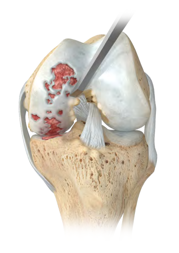 Arthrose du genou ou gonarthrose vers la prothèse totale de genou ISCO Institut Spécialisé