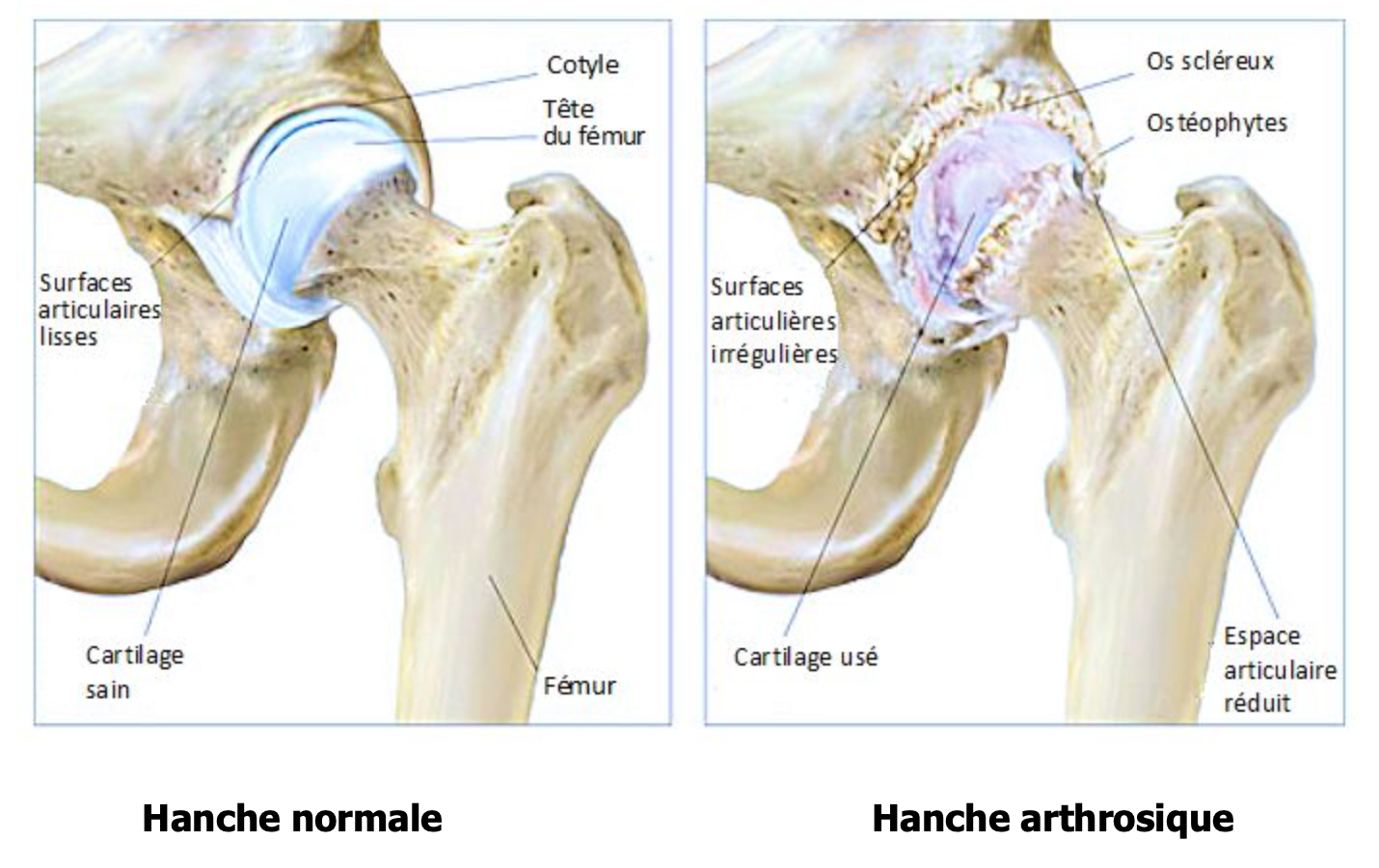 Arthrose De La Hanche Ou Coxarthrose Isco Institut Sp Cialis De Chirurgie Orthop Dique