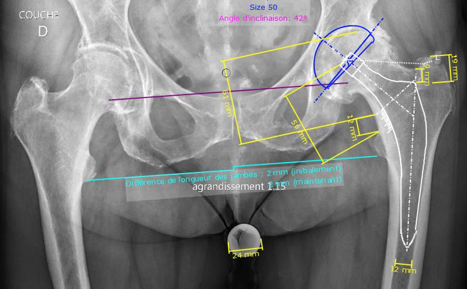 Arthrose De La Hanche Ou Coxarthrose Isco Institut Sp Cialis De Chirurgie Orthop Dique