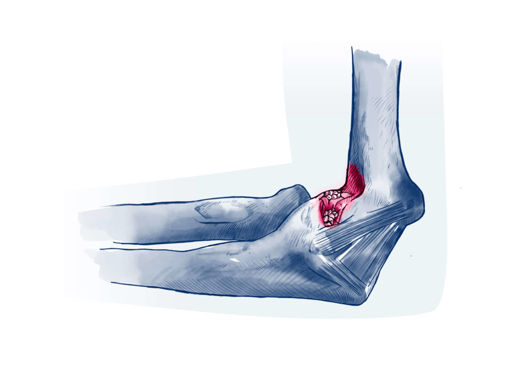 Pathologies Coude ISCO Institut Spécialisé de Chirurgie Orthopédique à StrasbourgISCO